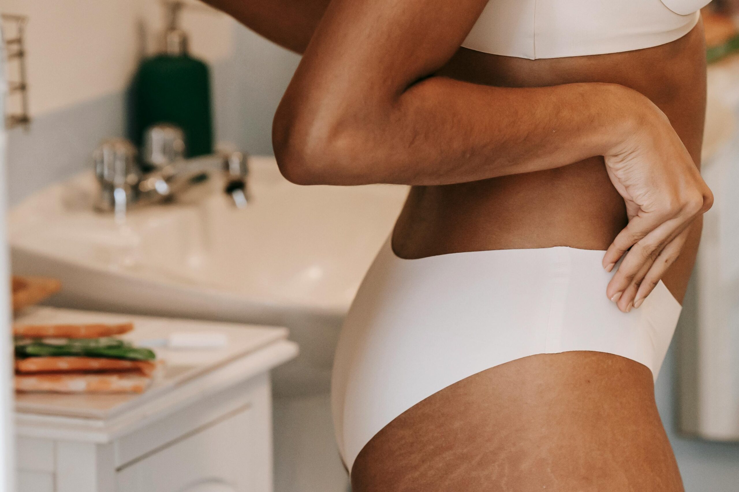 How do you prevent and treat stretch marks?